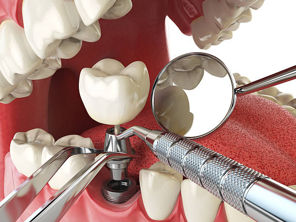 Best Emergency Denture Repair in University, FL